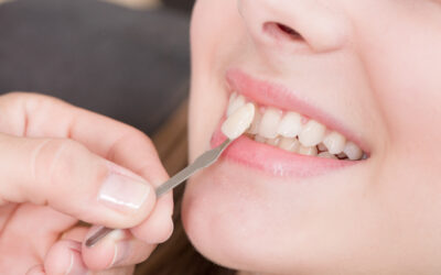 Le faccette dentali come soluzione estetica definitiva