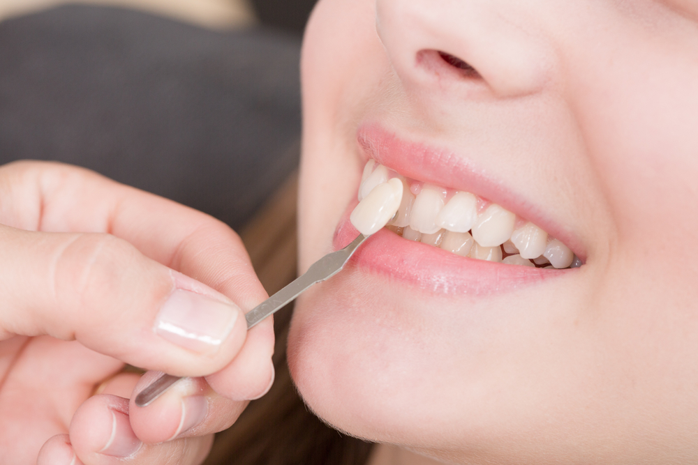 Le faccette dentali come soluzione estetica definitiva