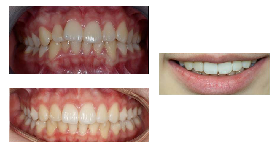 Ortodonzia invisibile Invisalign ortodonzia invisibile