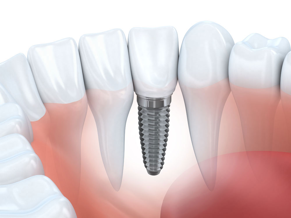 impianti dentali bisegna