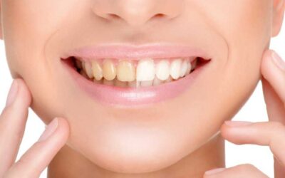 Sbiancamento dei denti: l’estetica dentale al servizio del sorriso