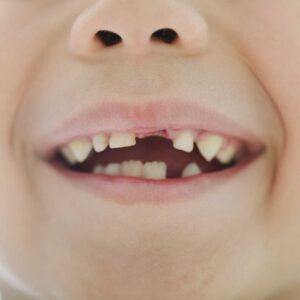 bocca senza incisivi di un bambino di circa sei anni