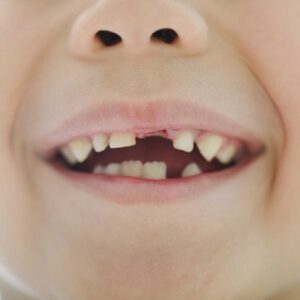 bocca senza incisivi di un bambino di circa sei anni