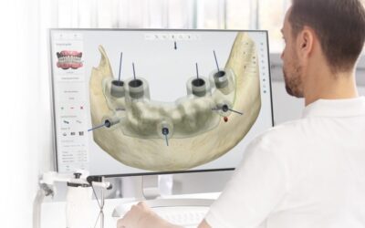 Implantologia computer guidata: cos’è e quali sono i vantaggi?