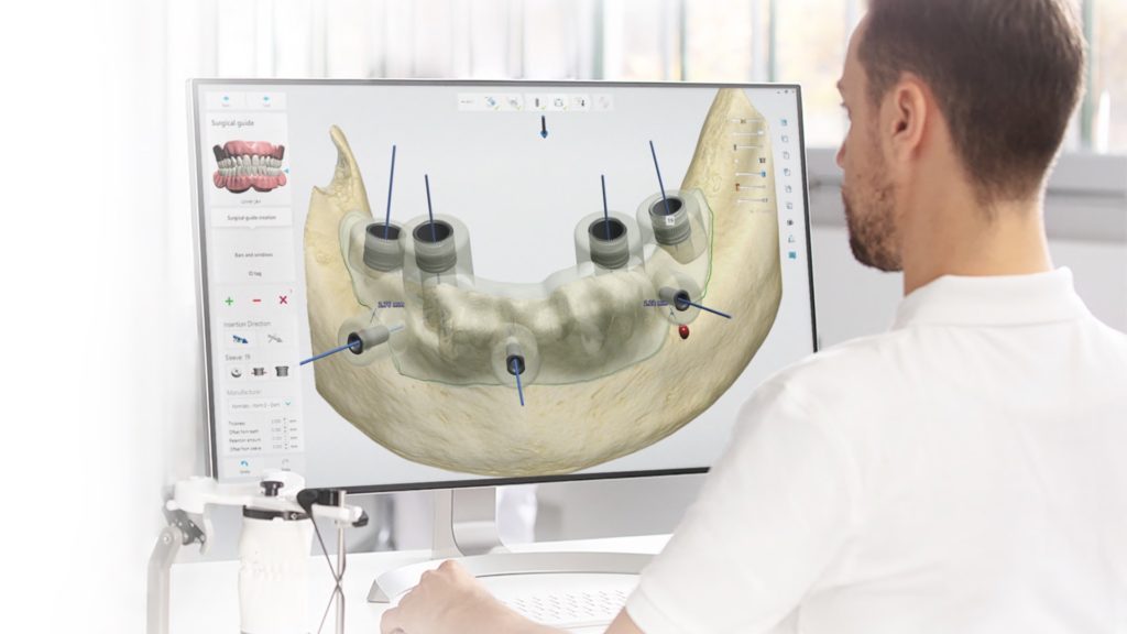 Implantologia computer guidata